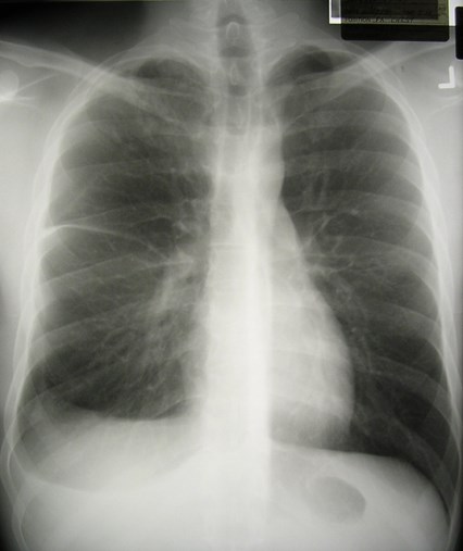 G:\photos\infection\Tuberculosis\primary RUL, eff\pa1.JPG